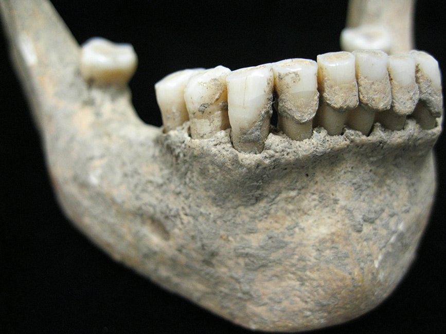 Jaw of a Medieval Individual from Germany with calculus